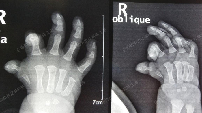 漂浮拇：成功保五指｜案例41：《让“漂浮拇”宝宝也能稳稳抓握》